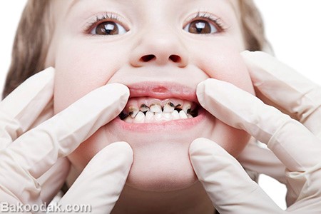 دلیل عمده تغییر رنگ دندان کودک